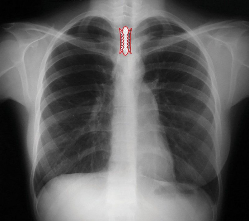 X-ray overlay showing notional position of the surgical stent in the trachea.